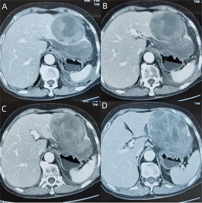 Giant Cell Tumor of Soft Tissue—A Rare Cause of Mass in the Liver: A Case Report